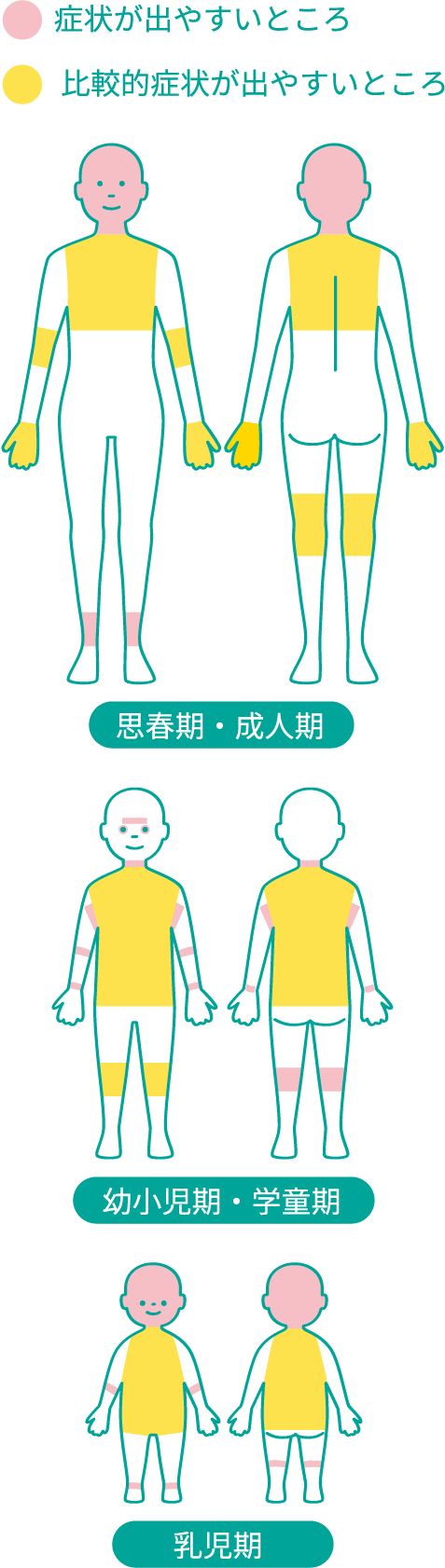 アトピー性皮膚炎の湿疹が出やすいところ